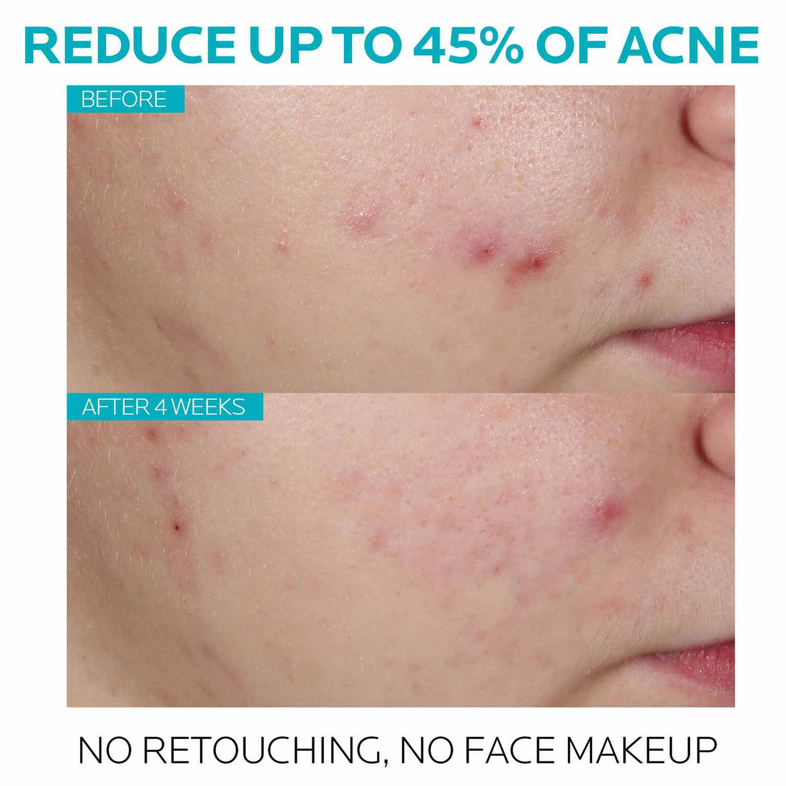 effaclar-salicylic-acid-acne-treatment-serum-i0 7_EffaclarSerum_After-45-days.jpg
