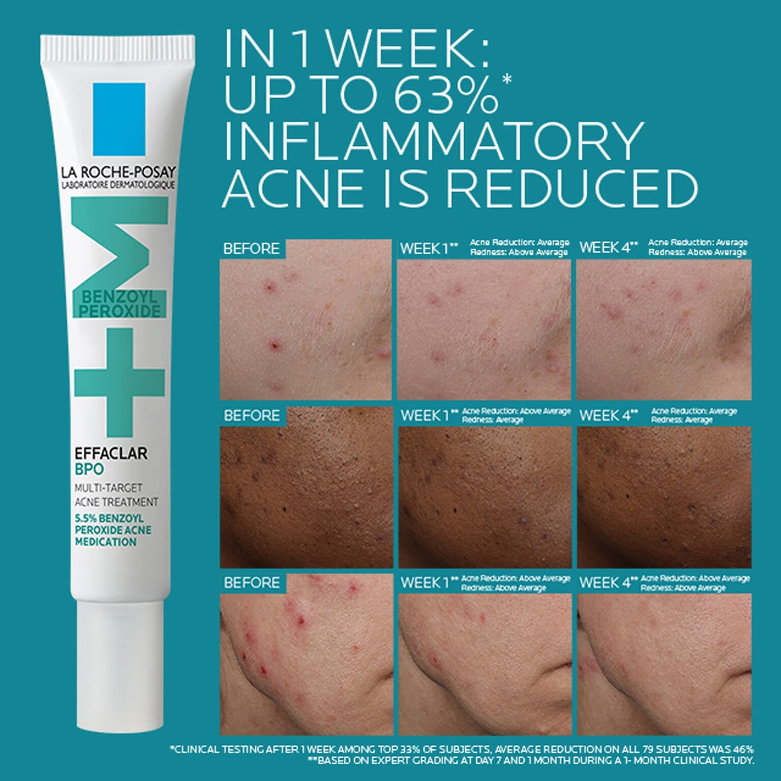 effaclar-bpo-multi-target-acne-treatment-with-5-5-benzoyl-peroxide-n1 EffaclarBPO-ClinicalBA-ATF-1500x1500-2.jpg