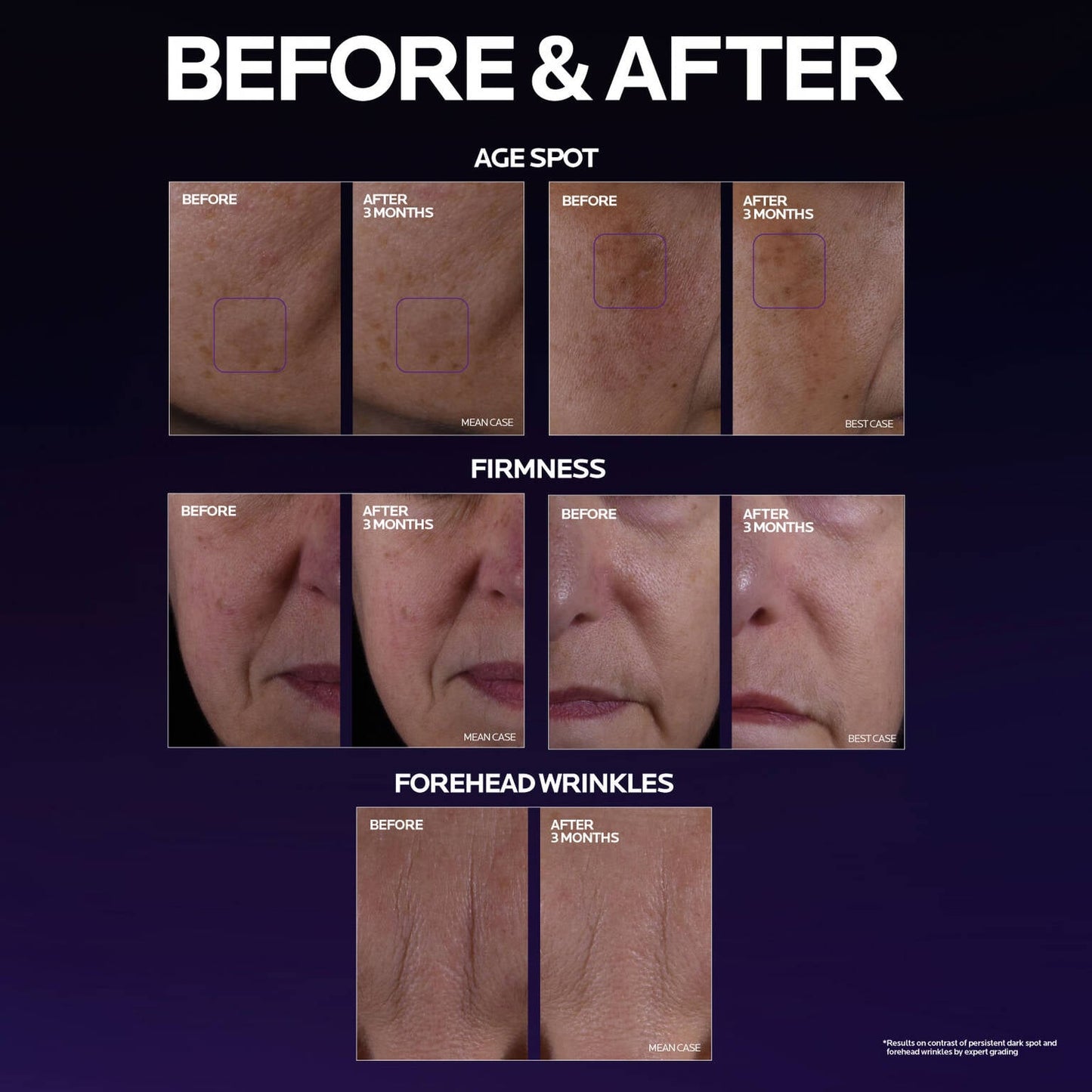 mela-b3-double-dose-discoloration-treatment-with-melasyltm-o5 MelaB3_DD_BTF_BeforeAfter_1500x1500_5.jpg