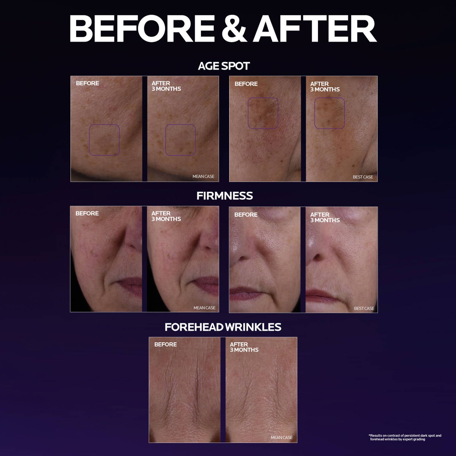mela-b3-double-dose-discoloration-treatment-with-melasyltm-o5 MelaB3_DD_BTF_BeforeAfter_1500x1500_5.jpg